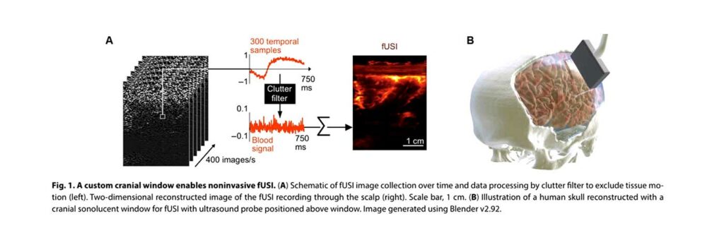 Real-time fUS imaging of human brain activity through an acoustic window. Iconeus.